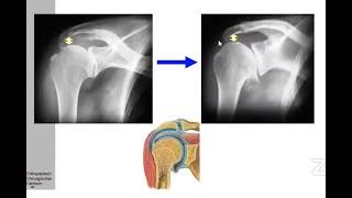 Principles of Anatomic Vs Reverse Shoulder Arthroplasty