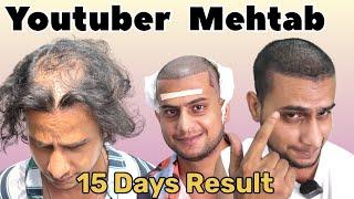 Round 2 Hell fame Mehtab’s 15 days Hair transplant Result | Best Hair transplant Result in india