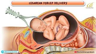 Mastering Caesarean Forceps Delivery: A Step-by-Step 3D Animation Guide