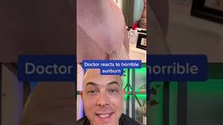 Derm reacts to horrific sunburn! #sunburn #wearsunscreen #dermreacts #doctorreacts