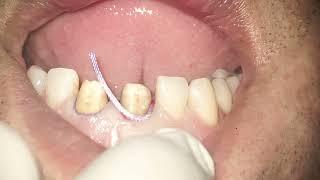 front teeth preparation