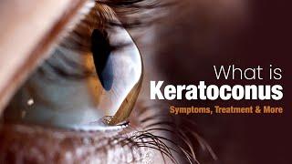 What is Keratoconus - Symptoms, Treatment and More