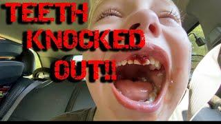 TEETH KNOCKED OUT!!