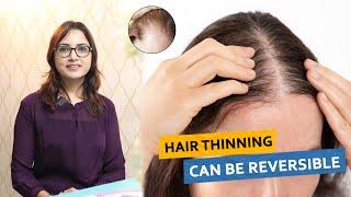 Hair Thinning Can Be Reversible? | Dr. Deepika Lunawat