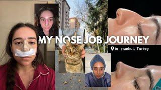 i got a rhinoplasty in TURKEY & documented the whole journey *nose job vlog*