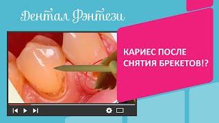 ‍️  Кариес после снятия брекетов!?