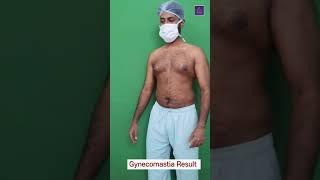 Gynecomastia Result after 21 Days | Best Gynaecomastia Surgeon in Kolkata #ytshorts