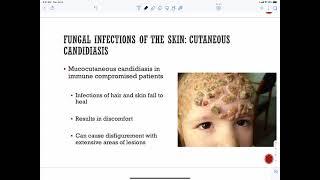 Fungal infections of the skin