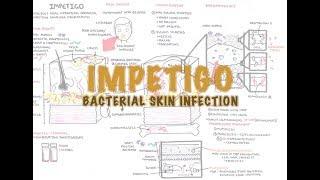 Impetigo Bacterial Skin Infection - Overview (Clinical Presentation, Pathophysiology, Treatment)