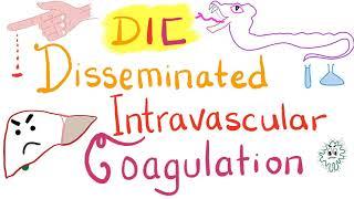 Disseminated Intravascular Coagulation (DIC)