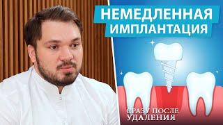 Можно ли ставить имплант сразу после удаления зуба? Одномоментная имплантация за 1 день!