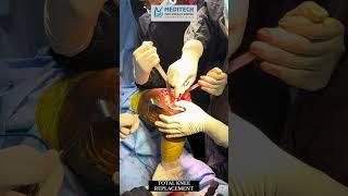 Total Knee Replacement | Best Orthopedic Hospital Hyderabad | Expert Surgeons | Maditech Hospitals
