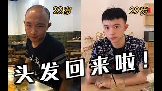 男生版亚洲换头术 | 6年来秃头小伙对自己的头发都做过什么？