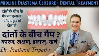 दाँतो के बिच मे gap आ जाए तो क्या करे | Midline Diastema in Hindi | सामने के दांत में गेप का इलाज