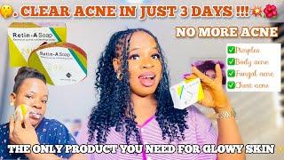 HOW TO USE RETIN-A SOAP 24K TO CLEAR ACNE| Get Rid of acne in 3 days + How To Achieve A Glowing Skin