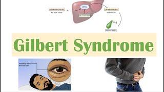 Gilbert Syndrome | Causes (Genetics), Pathogenesis, Signs & Symptoms, Diagnosis, Treatment