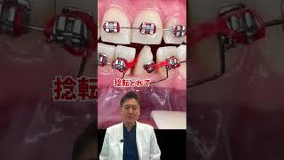 歯が真横でも治ります！ #歯医者  #歯列矯正 #インビザライン  #美容  #矯正