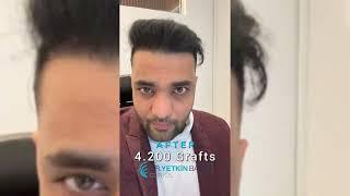 Hair Transplant Transformation that Brings Happiness!