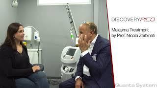 Melasma Treatment using the Discovery Pico By Prof.Nicola Zerbinati