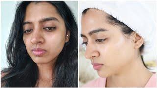 How I got Rid of Skin Pigmentation & Uneven Skin Tone