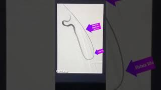 #Anatomy #Angiography #iRad  Hemodialysis #Fistula (Thrombosed and after thrombolysis)