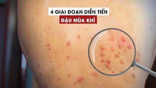 4 giai đoạn diễn tiến của bệnh đậu mùa khỉ
