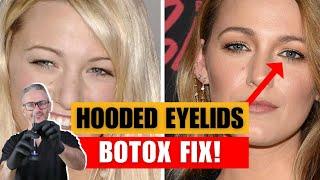 How to fix hooded eyelids with Botox. Brow ptosis vs hooded eyelid.