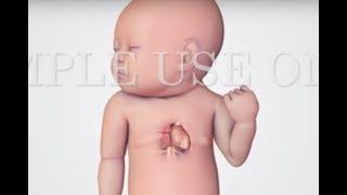 Hypoplastic Left Heart Syndrome | HLHS | Nucleus Health