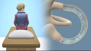 Epley Maneuver to Treat BPPV Vertigo