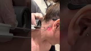 Quanta Q- Plus Laser Tattoo Removal