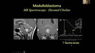 Neuroradiology of Medulloblastomas - Dr Suresh Mukherji MD MBA FACR & Dr Hemant Parmar MB BS