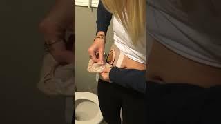 Emptying ileostomy using disposable biodegradable #ileostomy