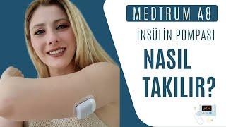 Medtrum A8 İnsülin Pompası: Akıllı Teknolojiyle Şeker Kontrolü