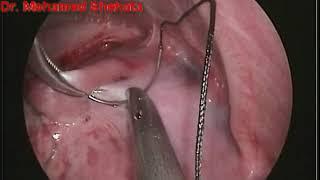 Dr. Mohamed Shehata, Thoracoscopic Congenital Diaphragmatic Hernia Repair, Tanta University, Egypt