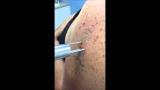 Laser Tattoo Removal(Amateur Tattoo): Northern Virginia at Skin Deep Laser Services Burke, VA