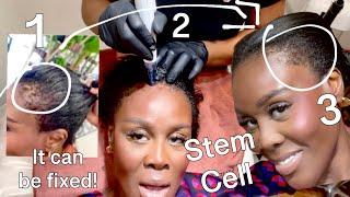 THE STEM CELL TREATMENT THAT WILL GROW YOUR EDGES BACK! NO NEED 4 HAIR TRANSPLANT! WOW