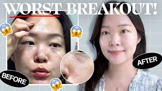 WORST BREAKOUT EVER?! What to do when your skin starts FREAKING OUT!