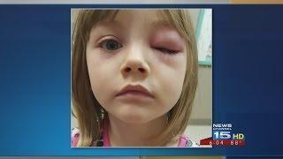 Mother claims water at Fox Island County Park caused daughter’s eye infection