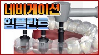 네비게이션 임플란트 수술 과정을 자세히 보여드립니다 GuidedDentalImplantPlacement 일반임플란트와 장단점