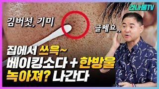 검버섯 흑자 기미 싹 녹아져 나갑니다? 베이킹 소다 와 이것 한방울??