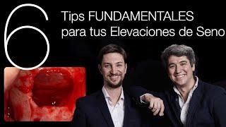  6 TIPS Fundamentales para la [Elevación de Seno] - Implantologia Avanzada