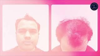 See the Remarkable Hair Transplant Transformation! | Hair Transplant in Mumbai | Dr. Umang Kothari.