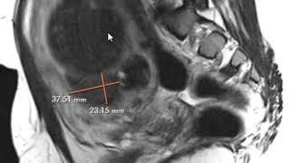 Uterine fibroids