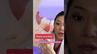 Pericoronitis. One of the reasons wisdom teeth have to come out. #wisdomteeth #dentist