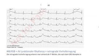 EKG in 3 Minuten [5]