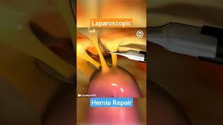 How Laparoscopic Mesh Repair Works for Hernia: A Step-by-Step Explanation #medical #meded  #hernia