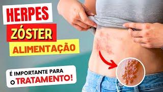 HERPES ZÓSTER - Alimentação CERTA no Tratamento e Sequelas