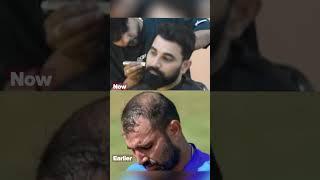 Mohd Shami's Hair Transplant Results at Eugenix: Before & After 10 Months Results