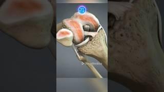 Total Knee Replacement Surgery (3D Animation)