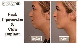 Real Life Experiences: A Patient's View of Facial Contouring I Dr. Thomas P. Sterry in NYC